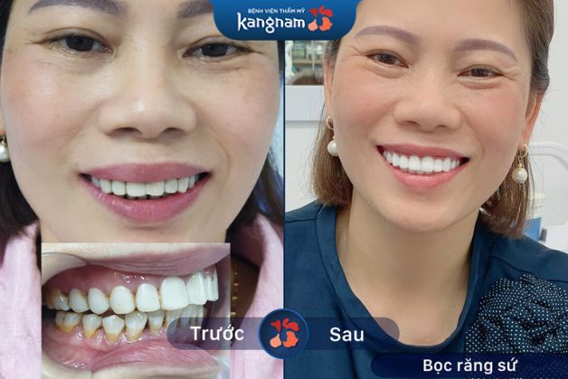 Cải thiện răng ố vàng hiệu quả