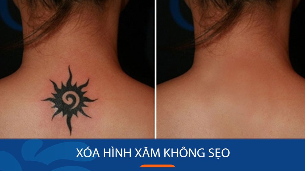 Xóa hình xăm không sẹo bằng laser và những điều cần lưu ý
