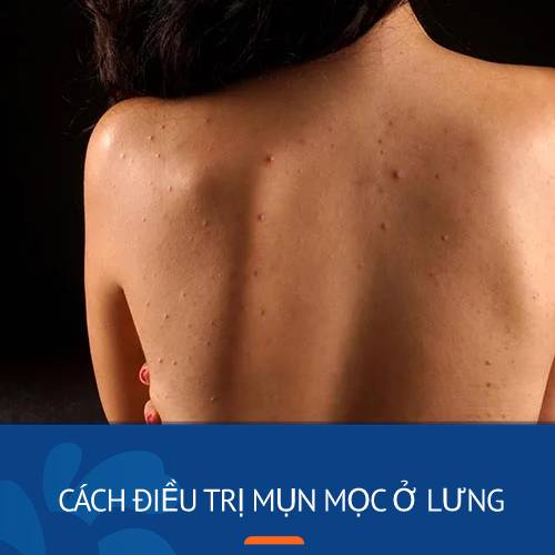 10+ Cách Trị Mụn Lưng Hiệu Quả Tại Nhà – Bí Quyết Cho Làn Da Mịn Màng