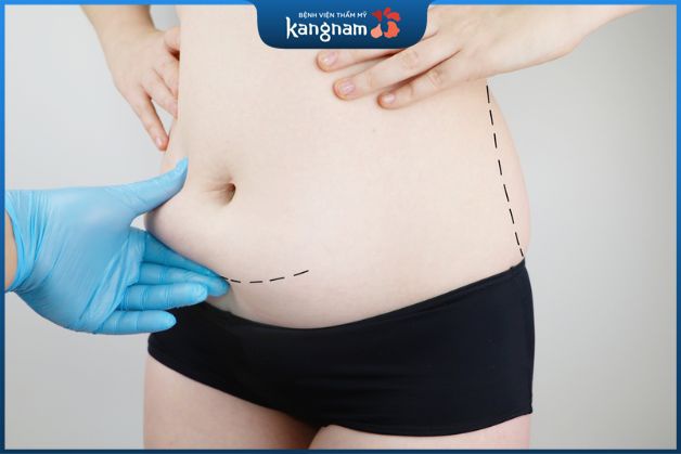 Tạo hình thành bụng mini có phạm vi can thiệp nhỏ