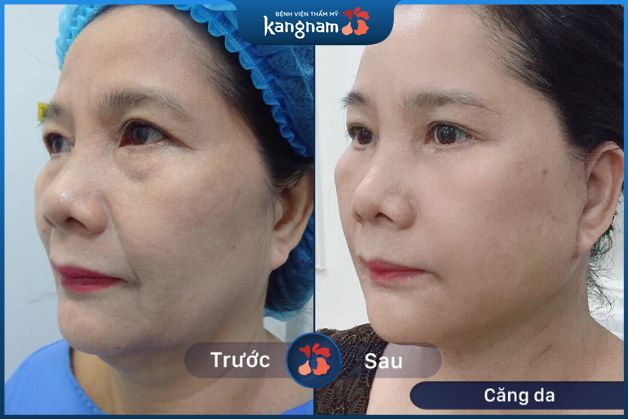 Căng da mặt an toàn, hiệu quả tại Kangnam