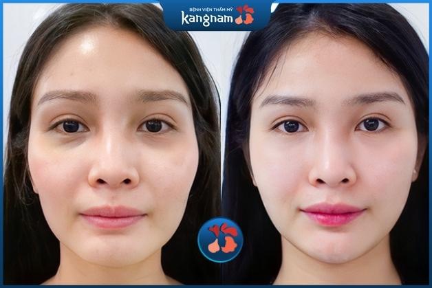 Cấy mỡ trẻ hóa toàn diện gương mặt chỉ sau 1 lần thực hiện tại Kangnam