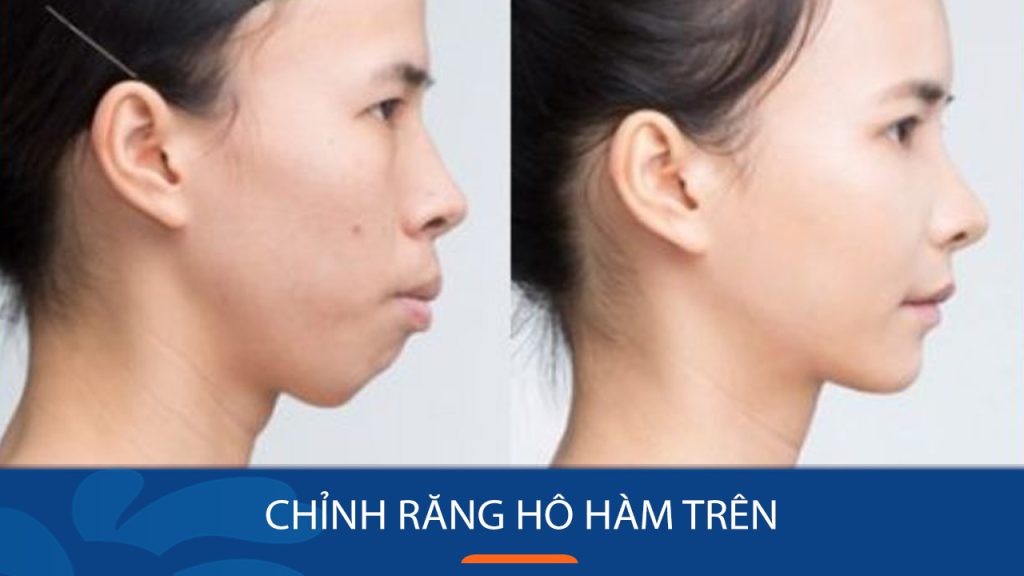 Chỉnh răng hô hàm trên : Giúp gương mặt cân đối, thon gọn