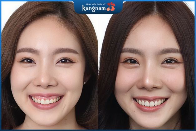 Phẫu thuật điều trị cười hở lợi tại Kangnam
