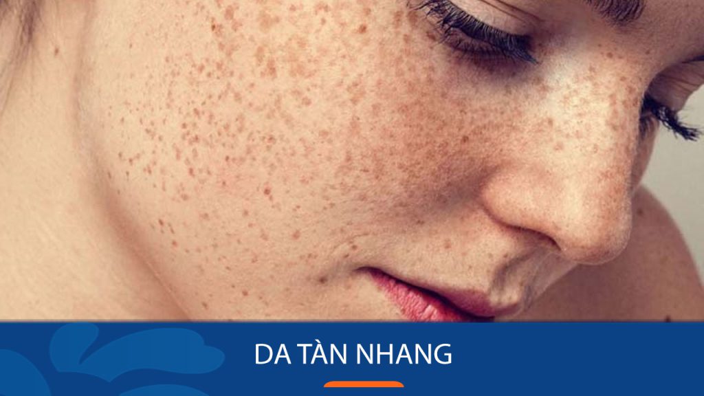 Da tàn nhang và 9 thực phẩm ‘xóa sổ’ đốm nâu hiệu quả