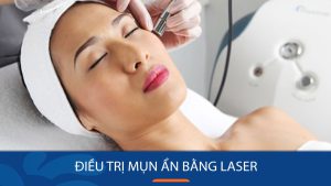 Điều trị mụn ẩn bằng laser: Giải pháp dứt điểm cho làn da sáng mịn!