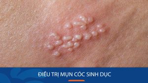 Bật Mí Bí Quyết Điều Trị Mụn Cóc Sinh Dục Dứt Điểm