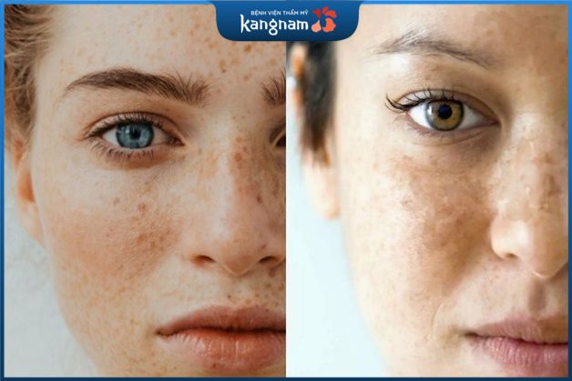 Những đối tượng có nguy cơ bị đốm đồi mồi