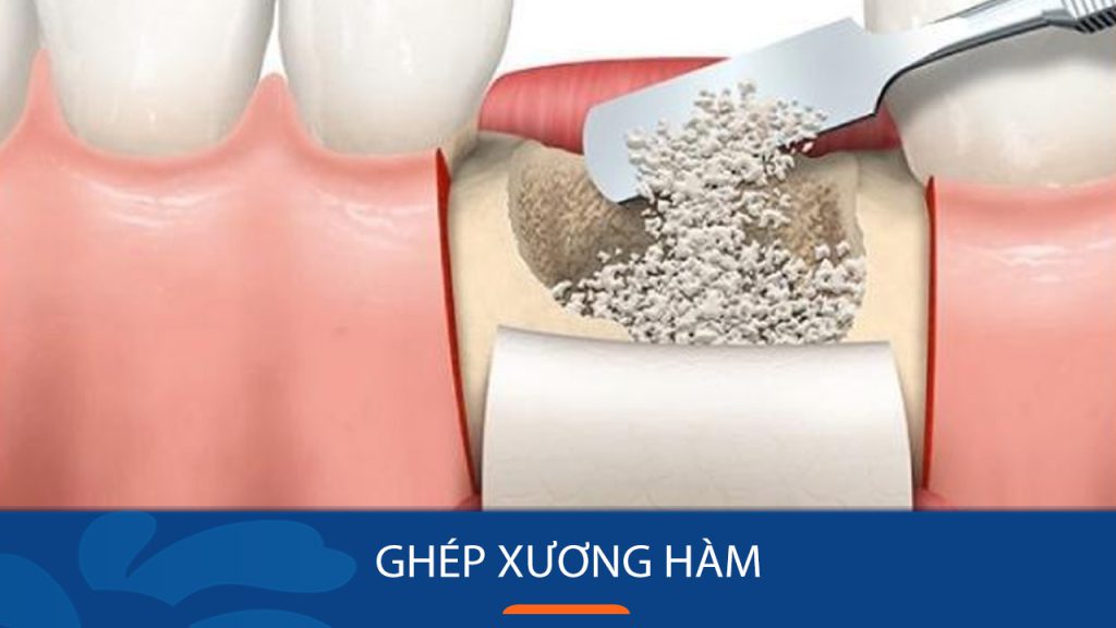 Ghép xương hàm – Giải pháp cho nụ cười rạng rỡ và sức khỏe răng miệng