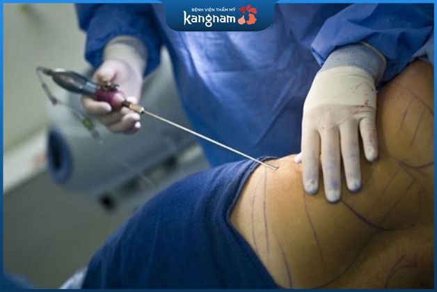 Quy trình hút mỡ ở lưng được Kangnam triển khai theo tiêu chuẩn an toàn