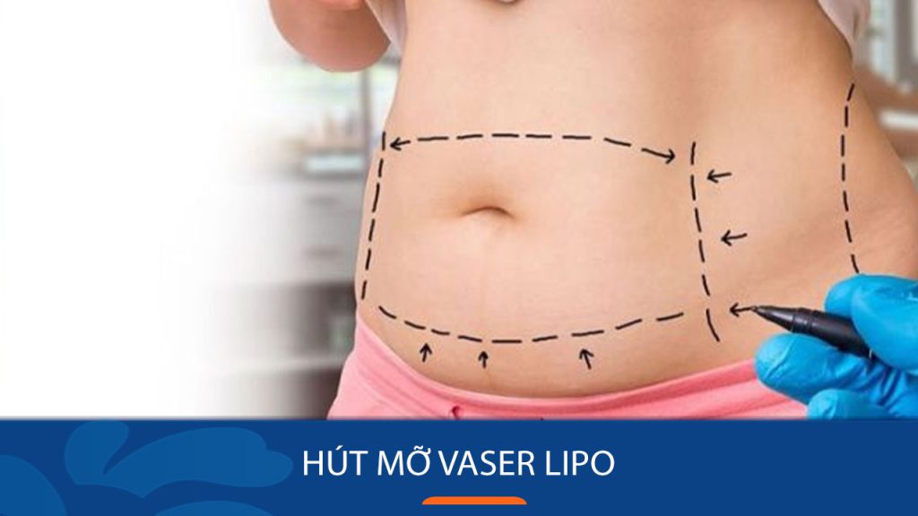 Hút mỡ Vaser Lipo – Vắt kiệt mỡ toàn thân, hạn chế xâm lấn