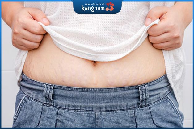 Mẹ bầu bị béo bụng và rạn da sau sinh nên sửa đổi thành bụng
