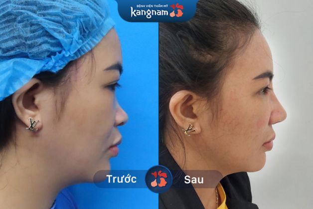 Cải thiện khuyết điểm mũi tẹt cho khách hàng