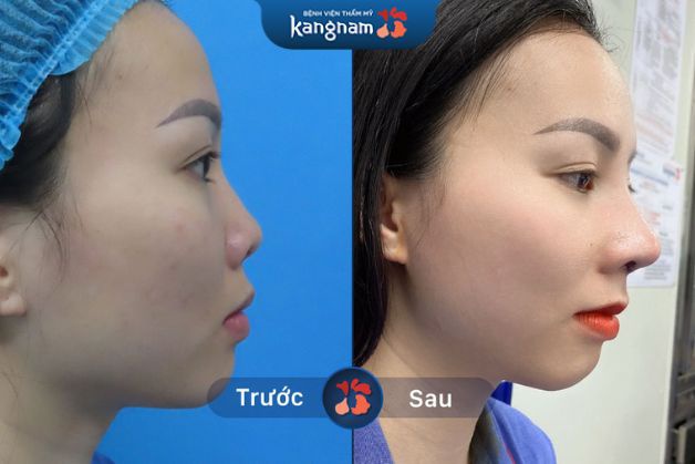 Đường sống mũi cao giúp tỷ lệ gương mặt cân đối hơn