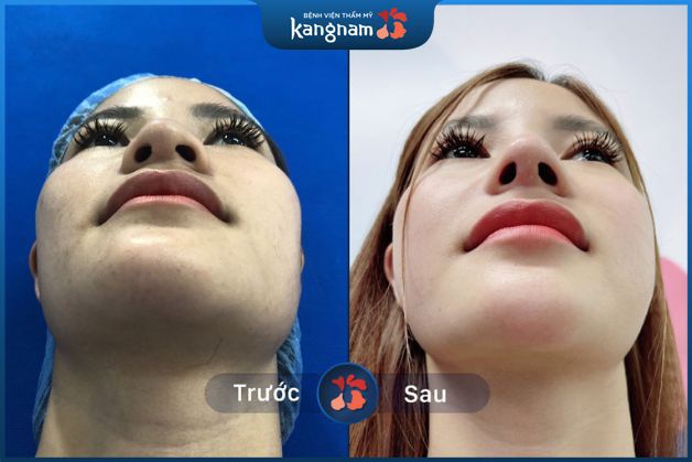 Giải cứu mũi hỏng lệch tại Kangnam