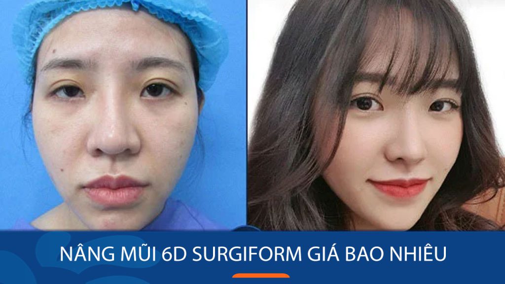 Nâng mũi Surgiform giá bao nhiêu?Bảng giá mới nhất