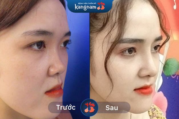 Sống mũi tự nhiên như thật