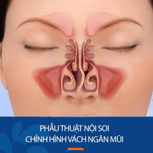 Phẫu thuật nội soi chỉnh hình vách ngăn mũi: 6 lưu ý cần biết
