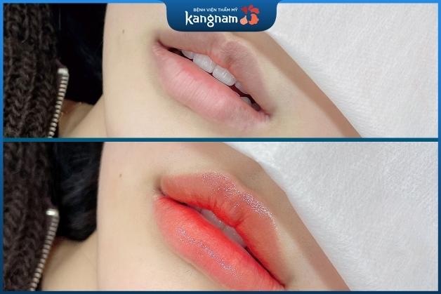 Phun môi Plascell đẹp ngay sau 1 lần thực hiện tại BV Kangnam