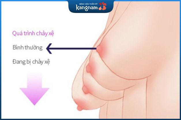 Các mức độ sa trễ ngực