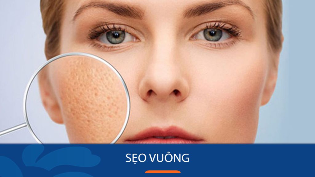 Sẹo vuông là gì? Nguyên nhân hình thành sẹo vuông?