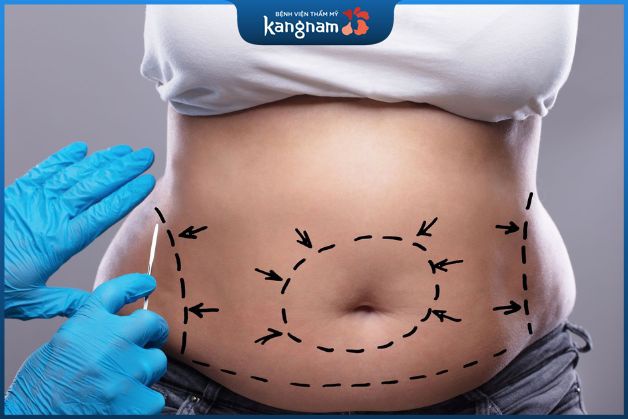 Tạo hình thành bụng toàn phần giúp cải thiện toàn bộ dáng vẻ vòng 2