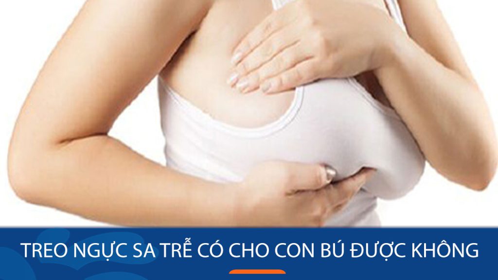 Treo ngực sa trễ có cho con bú được không? 5 Lưu ý cần biết