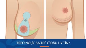 Treo ngực sa trễ ở đâu uy tín? 5 tiêu chuẩn chỉ có tại Kangnam