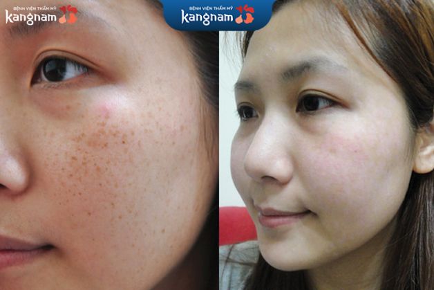 Da khỏe và bật tone sau khi trị tàn nhang