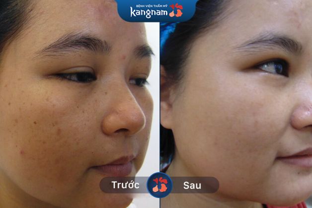Tàn nhang đồi mồi