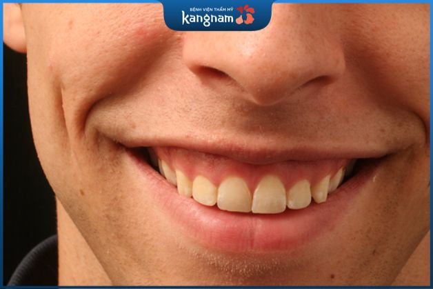 Tướng số răng ngắn cười hở lợi ở nam giới