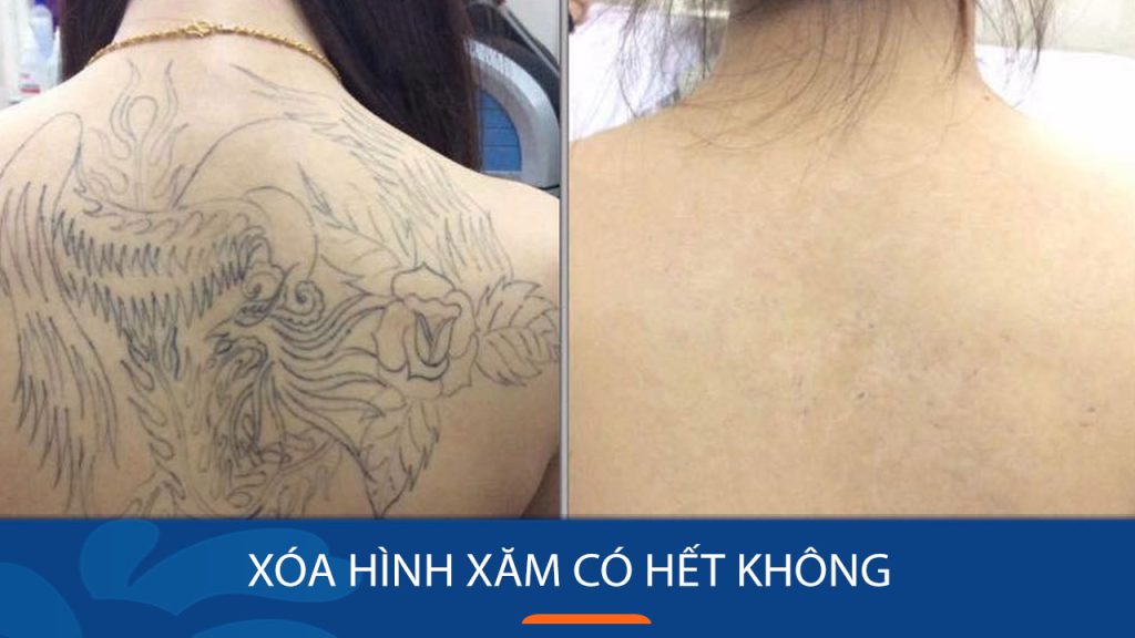 Xóa hình xăm có hết không? 4 Cách xóa xăm vĩnh viễn tại nhà