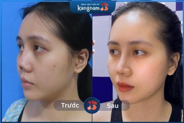Nâng/ sửa mũi hỏng sau nâng