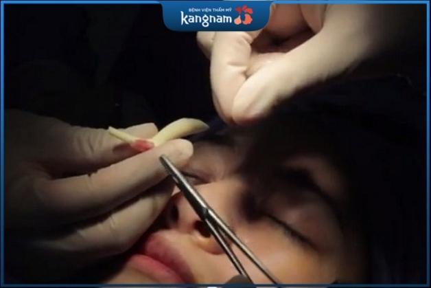 Các bác sĩ Kangnam tiến hành thẩm mỹ mũi cho khách hàng