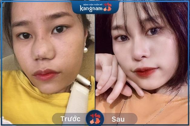 sửa mũi sau nâng9