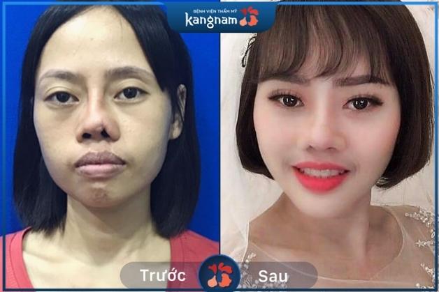 Nâng/ sửa mũi hỏng sau nâng 1