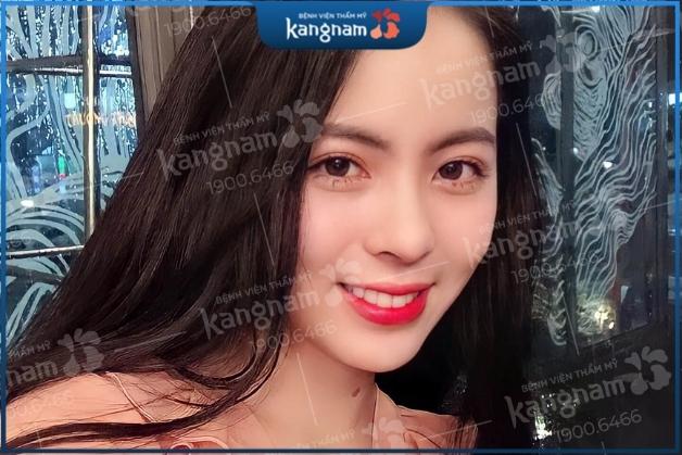 Thời gian kiêng ăn sau nâng mũi ngắn hay dài phụ thuộc vào cơ địa của mỗi người
