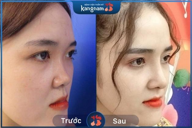Nâng mũi S-Line 3D – Giải pháp nâng mũi hoàn hảo nhất