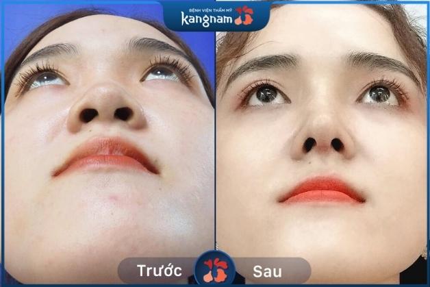 Kết quả nâng mũi tẹt tại Thẩm mỹ viện Kangnam