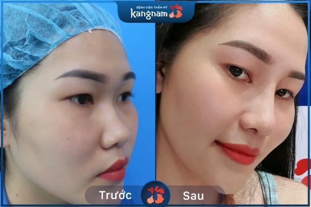 Thay đổi hoàn toàn diện mạo sau thu nhỏ đầu mũi kết hợp nâng mũi tại Kangnam