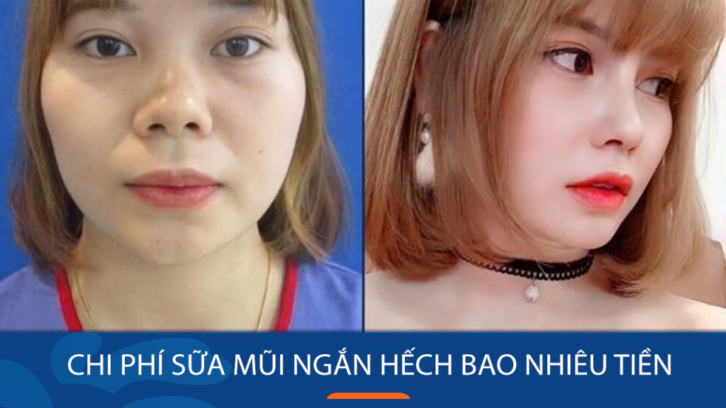Sửa mũi ngắn hếch giá bao nhiêu? Bảng giá mới nhất