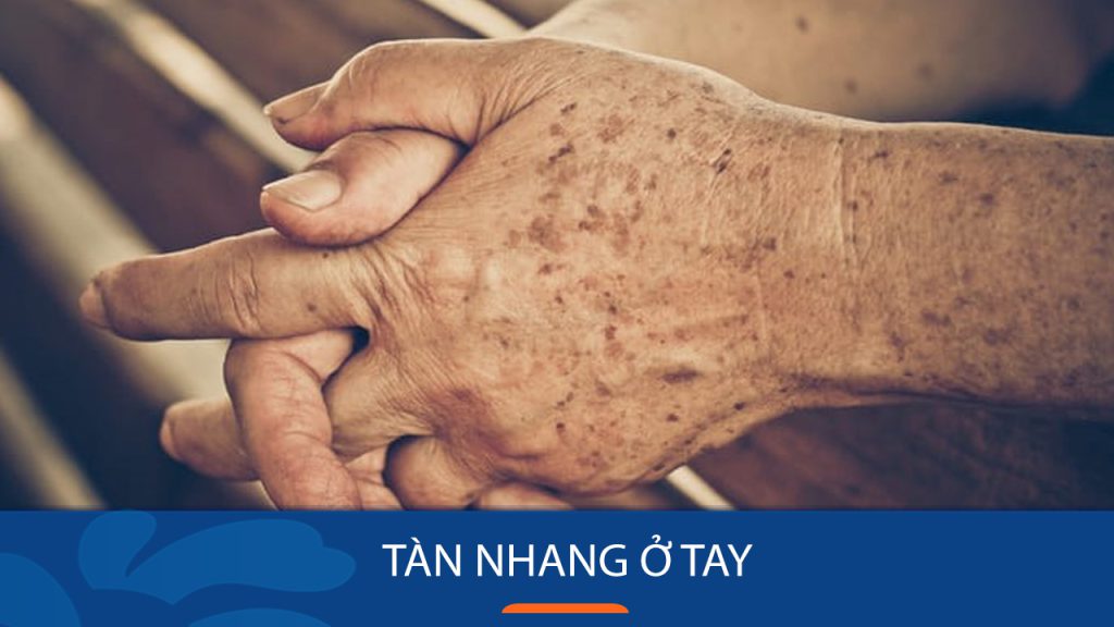 Dấu hiệu nhận biết tàn nhang ở tay? Điều trị tàn nhang hiệu quả