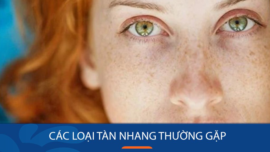 Các loại tàn nhang thường gặp – Bạn đang gặp phải loại nào