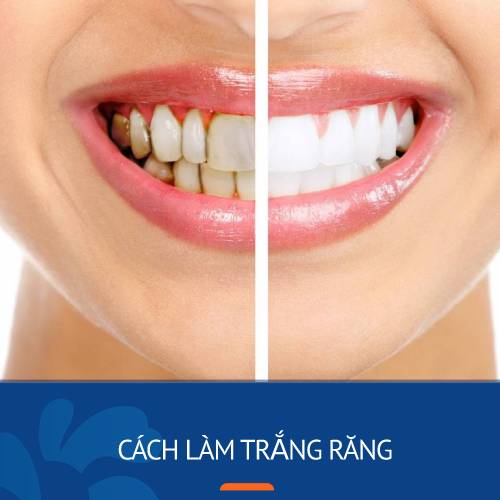 15 Cách làm trắng răng cấp tốc tại nhà hiệu quả chỉ sau 1 đêm