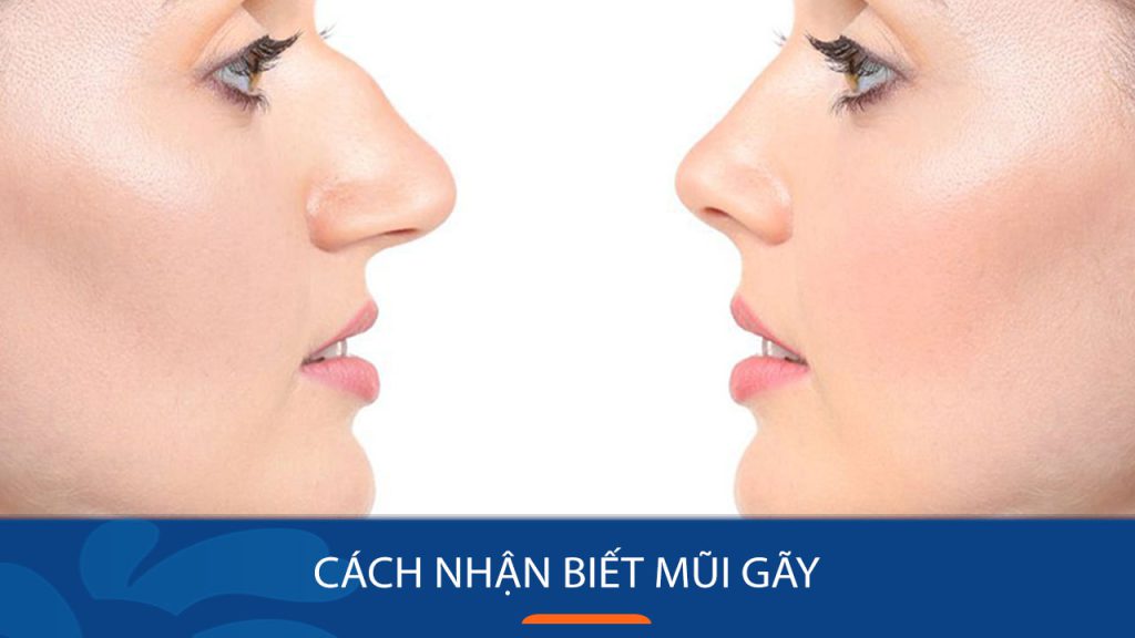 Cách nhận biết mũi gãy, mũi quặp, mũi hếch, mũi lân – Giải pháp nào cho bạn?