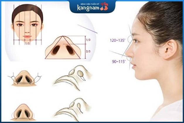 Cắt cánh mũi là tiểu phẫu đơn giản, làm đẹp cho phần đầu mũi