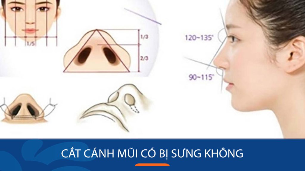 Cắt cánh mũi có bị sưng không? Sưng nhẹ chỉ trong 3 ngày