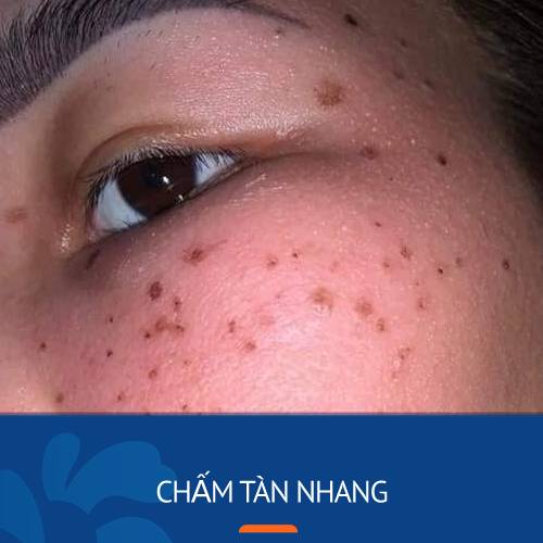  thuốc chấm tàn nhang 