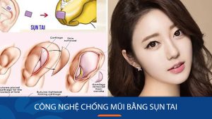 Đột phá công nghệ chống mũi bằng sụn tai chuẩn Hàn