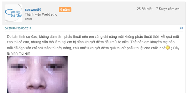 có ai nâng mũi không phẫu thuật chưa 9